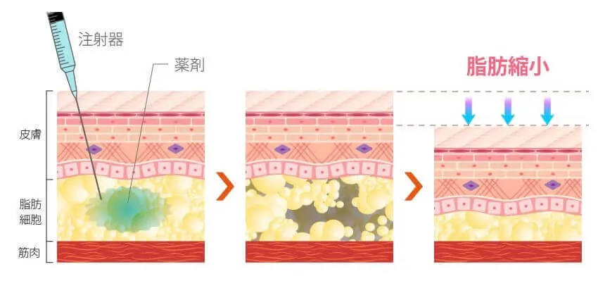 TCBの脂肪融解注射の皮膚画像