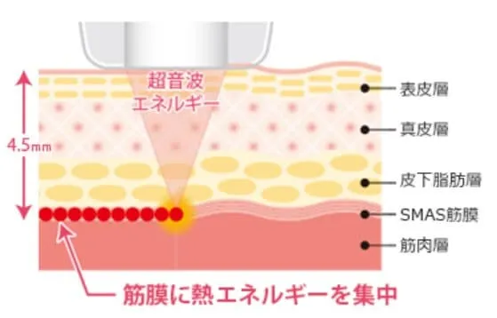 聖マリアビルのハイフの皮膚画像