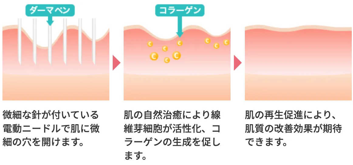 ダーマペン　解説