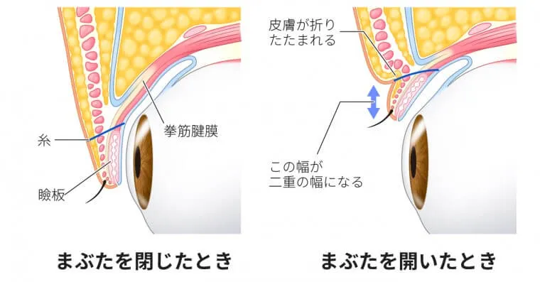 埋没法施術イメージ