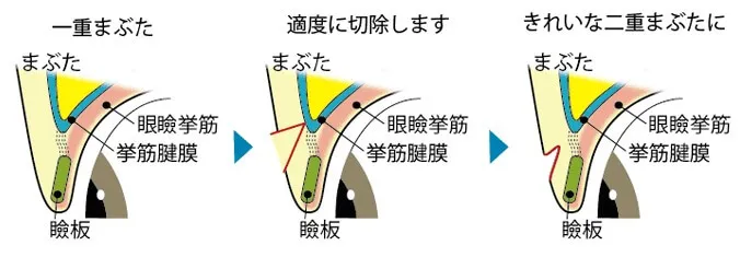 切開法施術イメージ