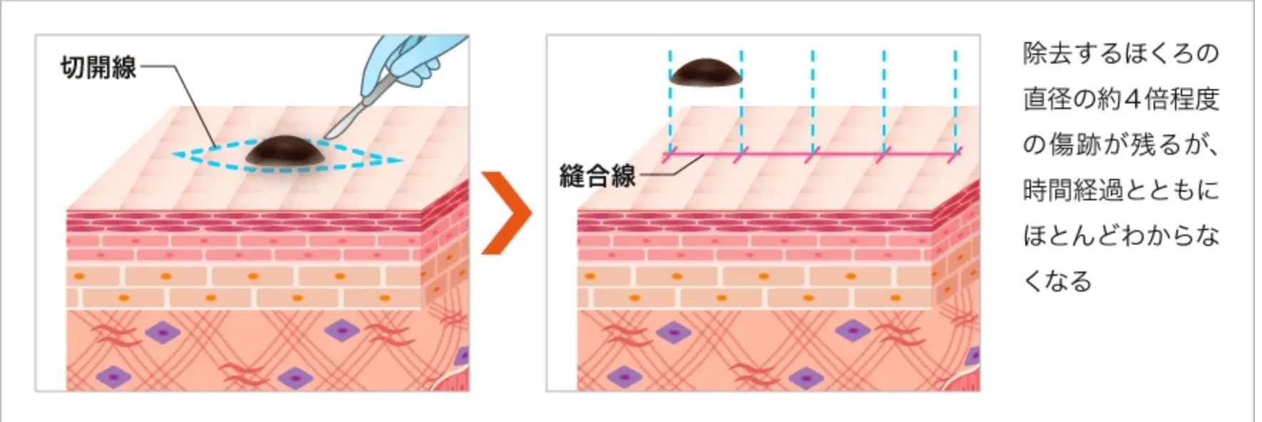 切開法解説