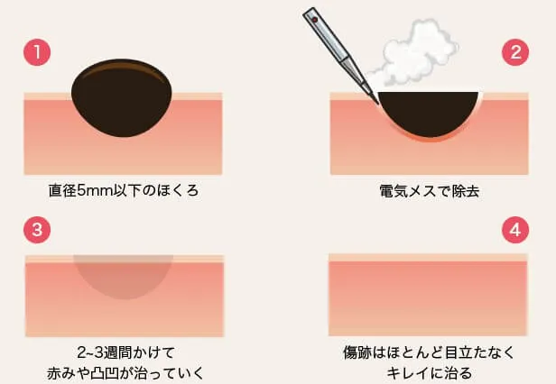 ほくろ除去電気メス