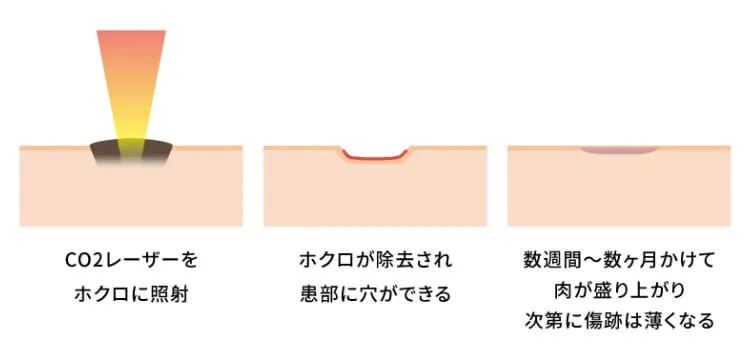 ほくろ除去レーザー