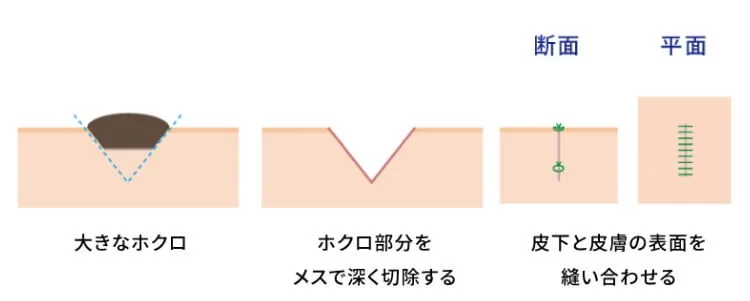 ほくろ除去切開