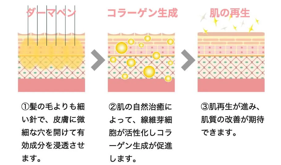 ダーマペン仕組み