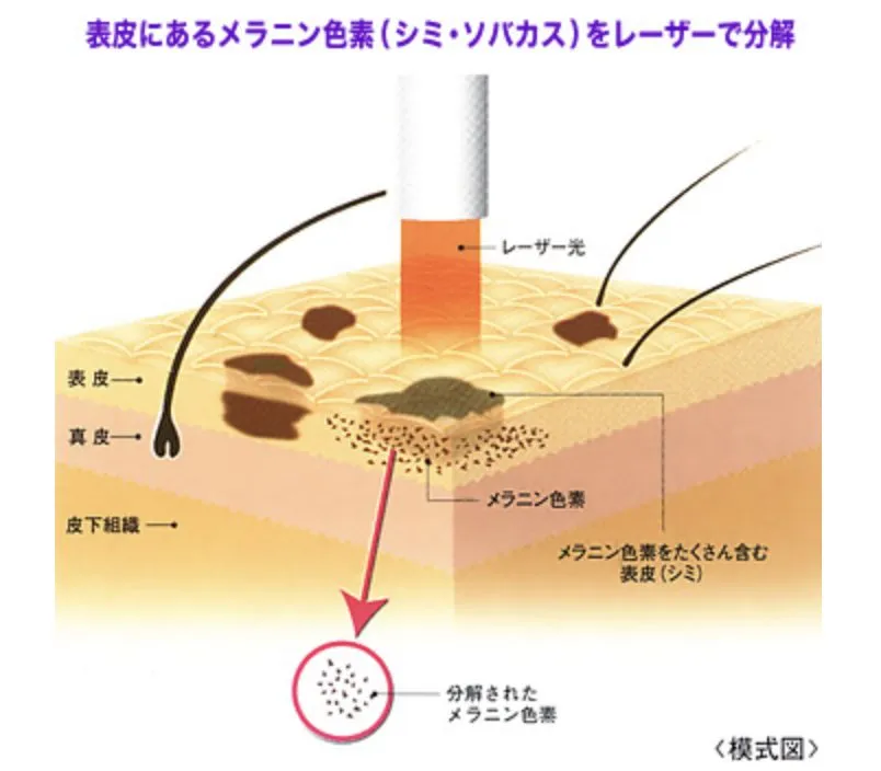 レーザー治療