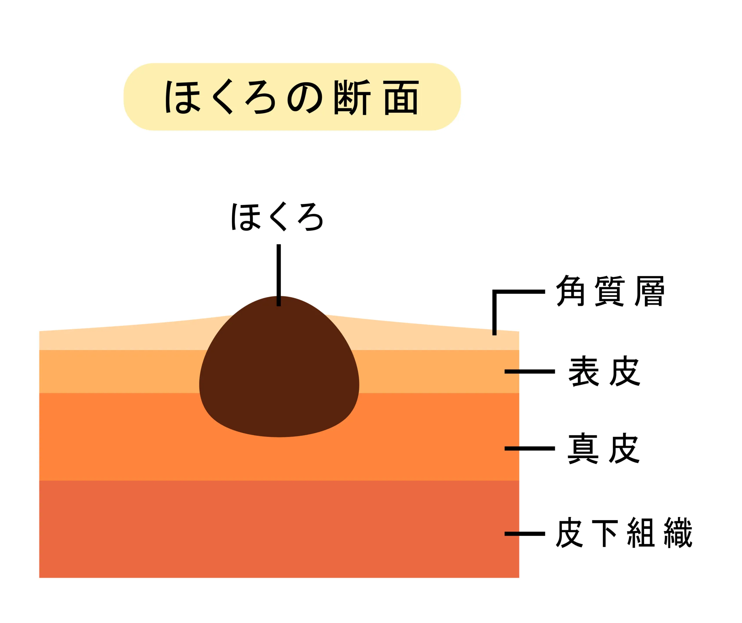 ほくろとは