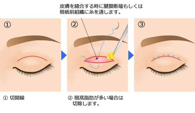 全切開