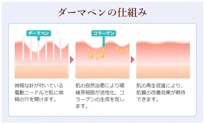 ダーマ仕組み