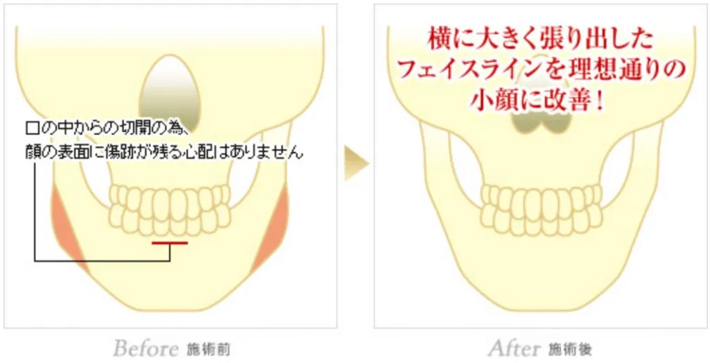 エラの骨削り