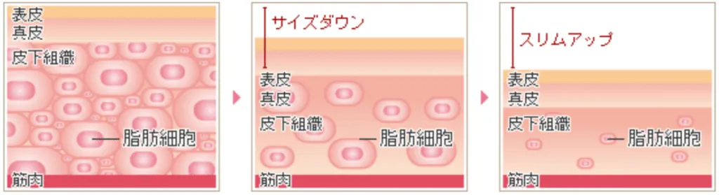 脂肪溶解注射