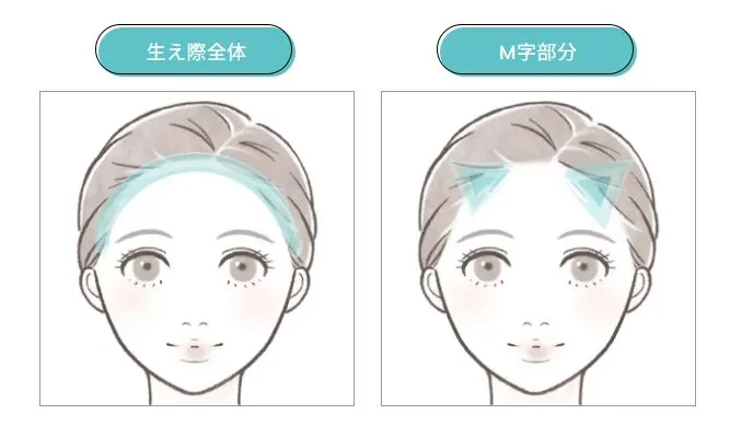 ヘアライン