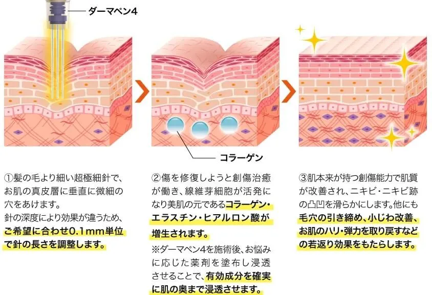 ダーマペン