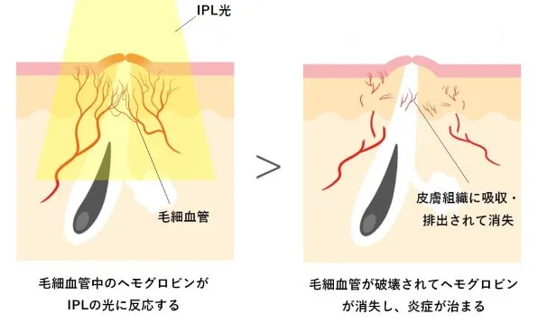 光治療炎症