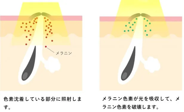 光治療メラニン