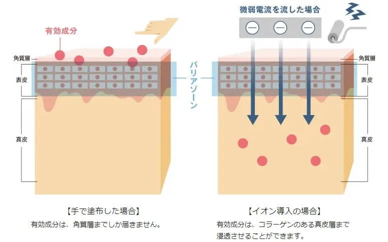 イオン導入