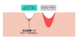 エルビウムヤグレーザー