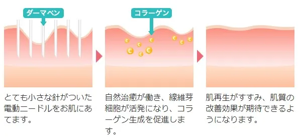 ダーマペン