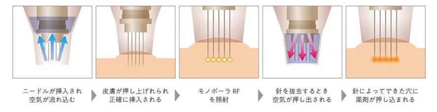 ドラッグデリバリーシステム