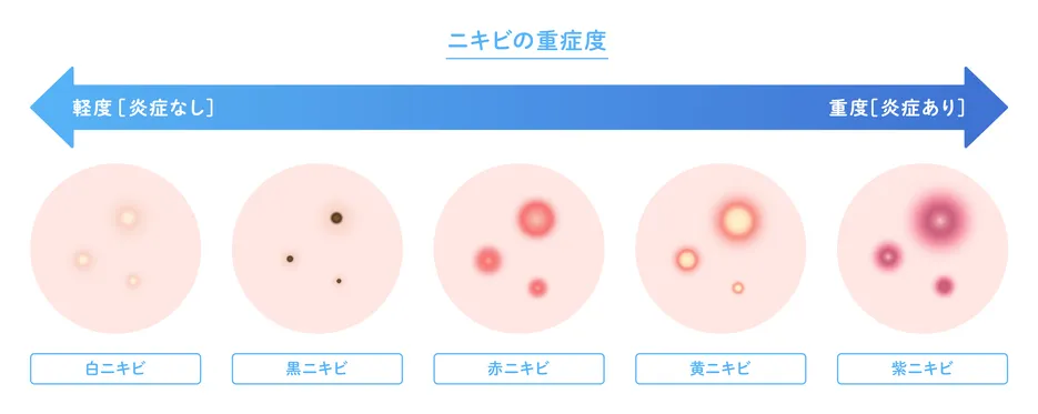 ニキビ跡ができるまでの流れ