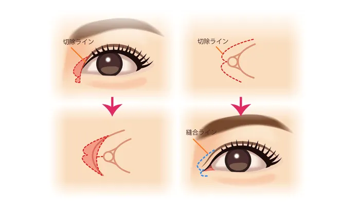 目頭切開
