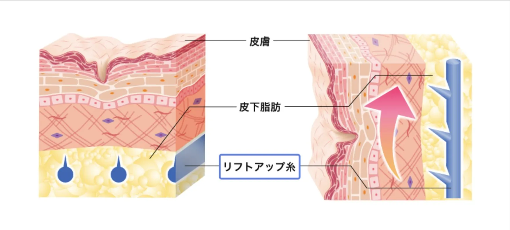 糸リフト解説２