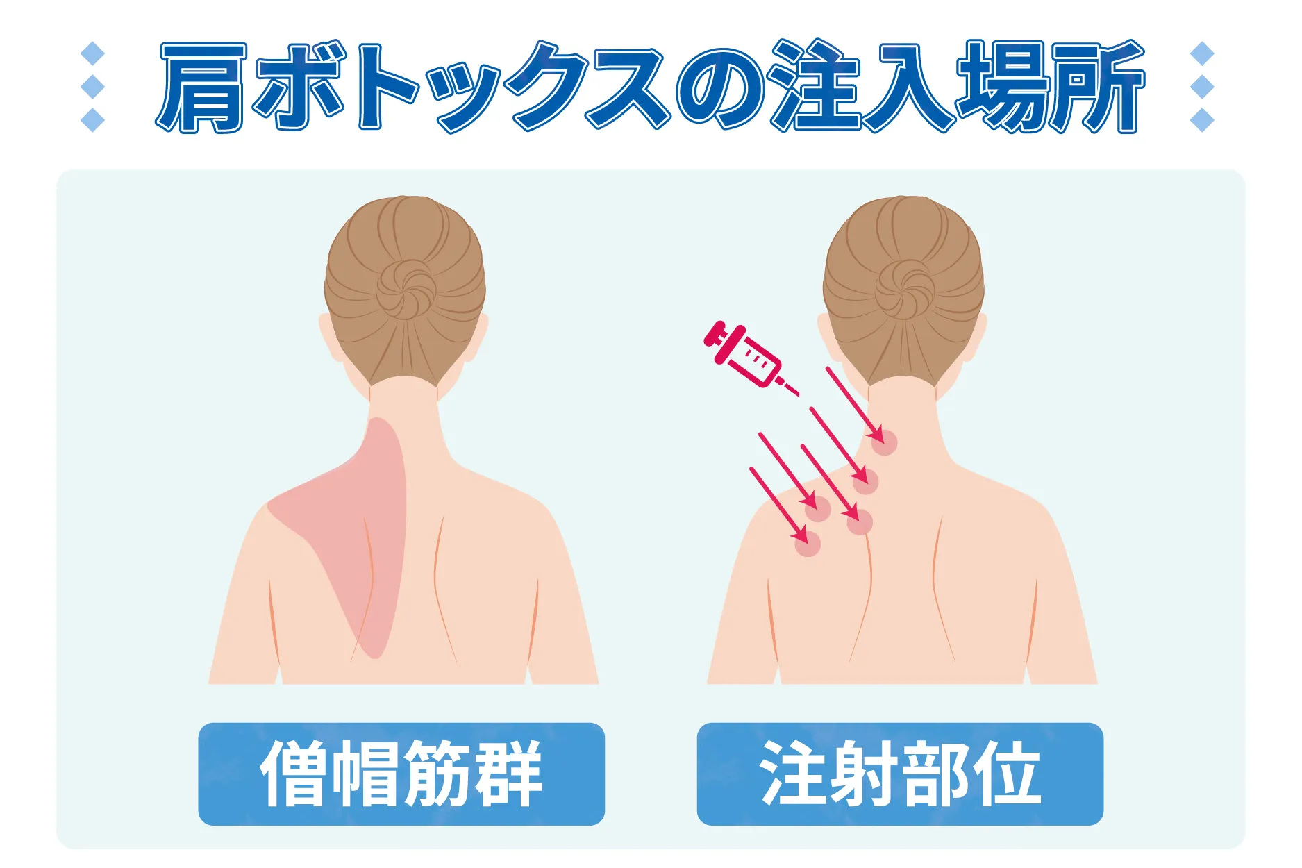 肩ボトックス注入場所