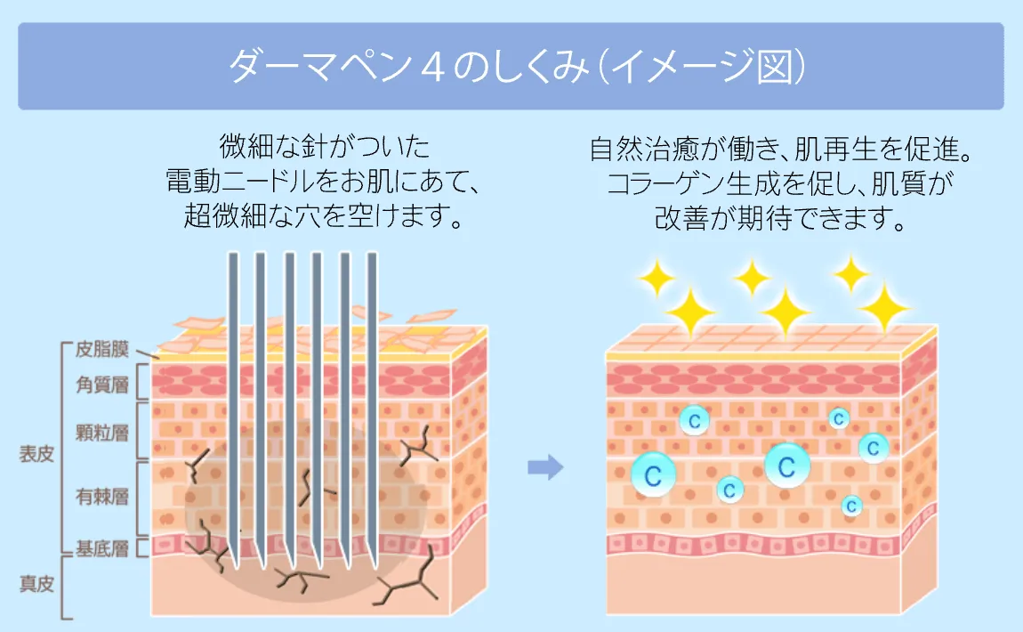 ダーマペンの仕組み