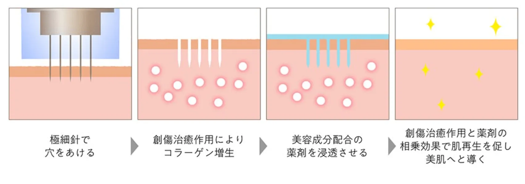 ポテンツァとダーマペンの違い