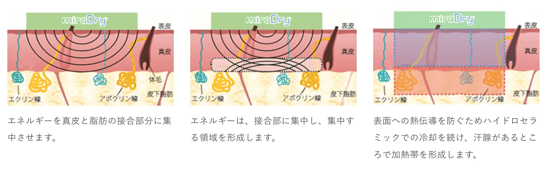 レーザー治療