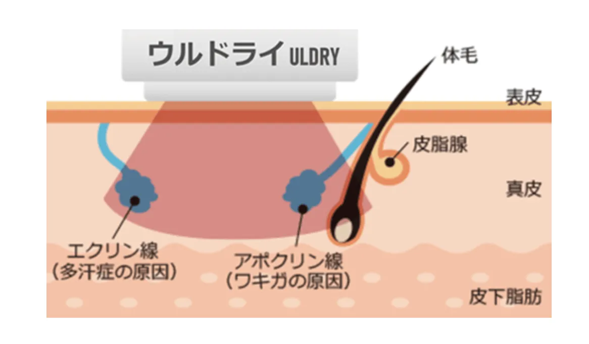 ミラドライとウルドライの違い