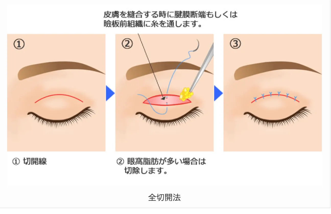 個性を出したいなら切開法