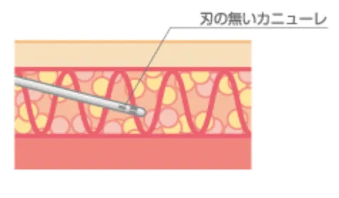 ベイザー法