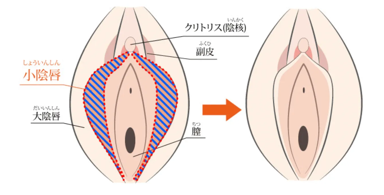 小陰唇縮小術とは