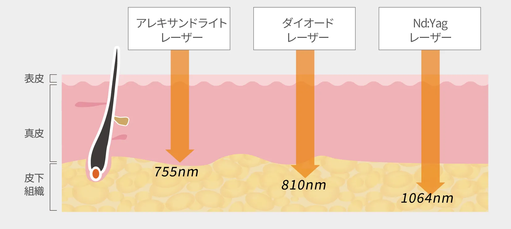 3種類のレーザーについて