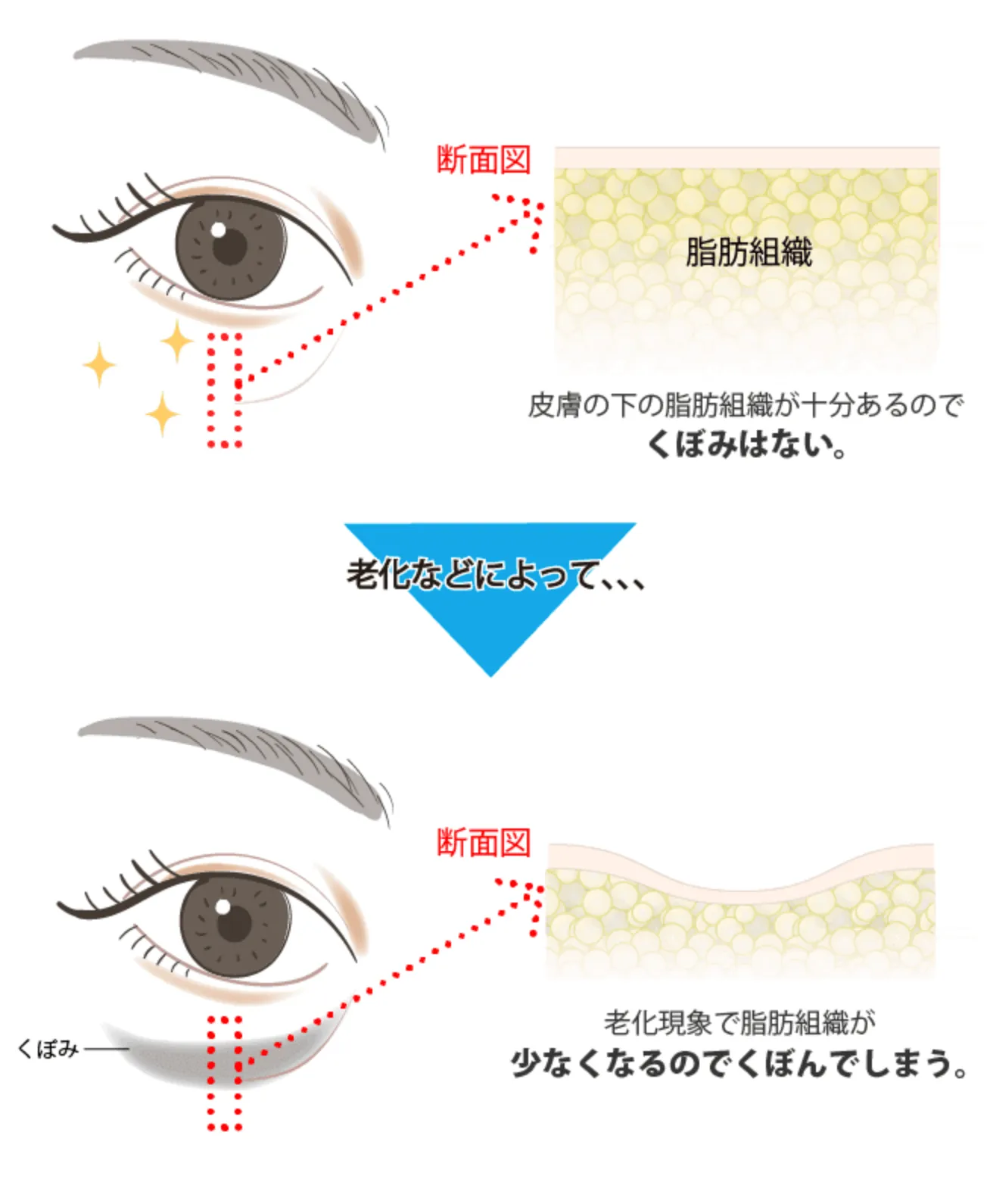 ヒアルロン酸注入